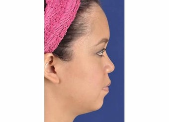 Chin Enhancement before 1357229