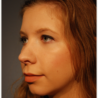 18-24 year old woman treated with Rhinoplasty after 3064866