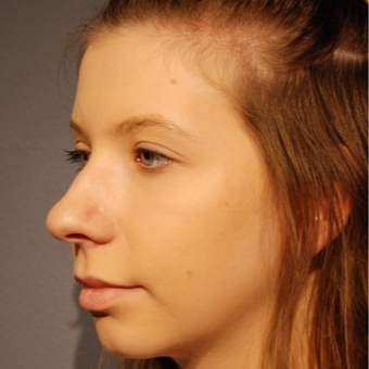 18-24 year old woman treated with Rhinoplasty before 3064866