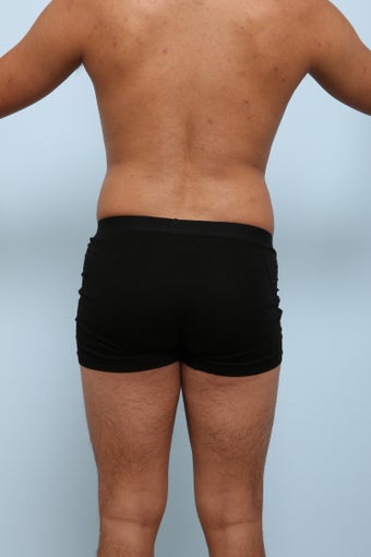 Brazilian Butt Lift before 2882220
