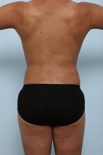 Brazilian Butt Lift after 2882220