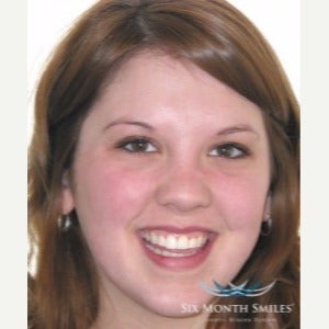 25-34 year old woman treated with Six Month Smiles after 2466162