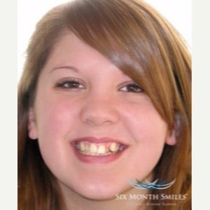 25-34 year old woman treated with Six Month Smiles before 2466162