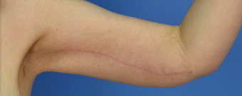 Brachioplasty - Arm Lift after 471877