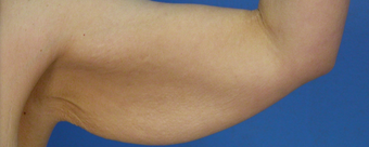 Brachioplasty - Arm Lift before 471877