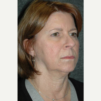 63 year old woman treated with Facelift before 3710758