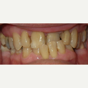 65-74 year old man treated with Damon Braces before 2262391