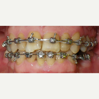 65-74 year old man treated with Damon Braces after 2262391