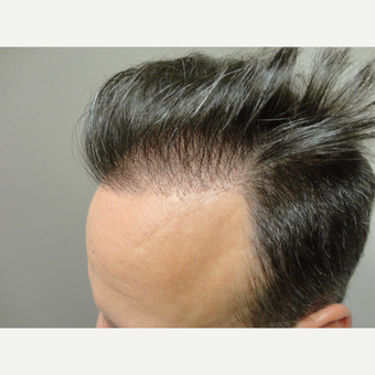 45-54 year old man treated with Hair Transplant before 3714787