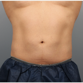 44 year old man treated with CoolSculpting of the Abdomen and Flanks after 3507470