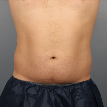 44 year old man treated with CoolSculpting of the Abdomen and Flanks before 3507470