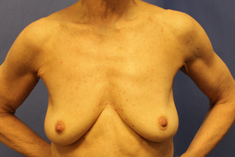 Breast augmentation with Mentor MemoryShape implants before 1373578