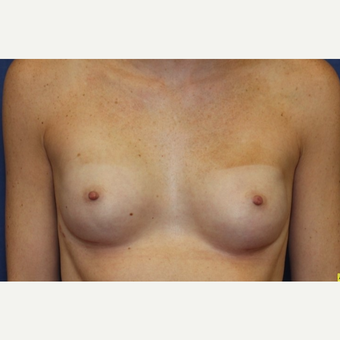 24 year old woman with a Breast Reconstruction after 3541612