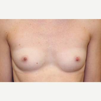 24 year old woman with a Breast Reconstruction before 3541612