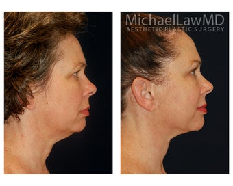 Neck Lift before 1325336