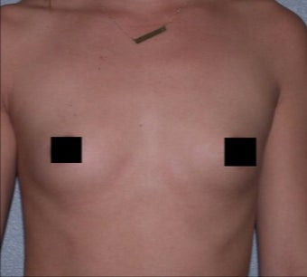 23 year old woman treated with Breast Augmentation before 3282308