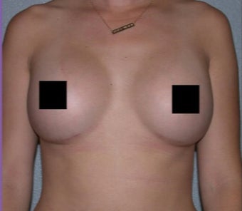 23 year old woman treated with Breast Augmentation after 3282308