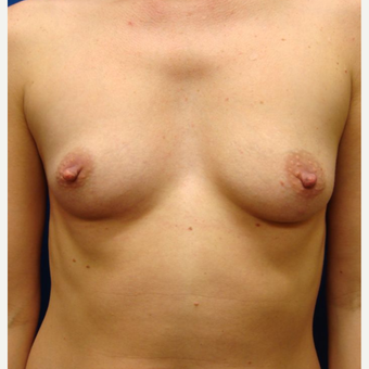 25-34 year old woman treated with Breast Implants before 3670044