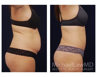 Liposuction before 1284256