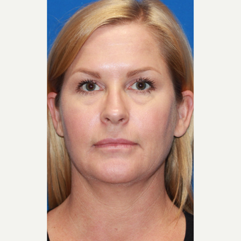 45-54 year old woman treated with Facelift before 3665989