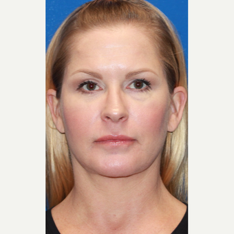 45-54 year old woman treated with Facelift after 3665989