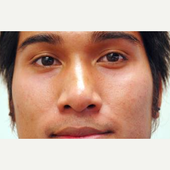 25-34 year old man treated with Acne Treatment after 3499364