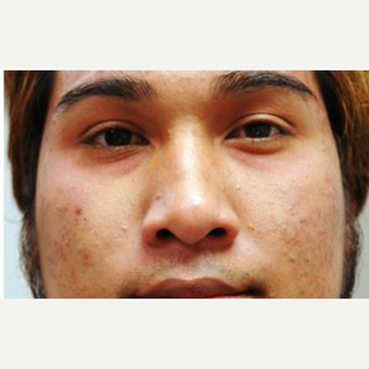 25-34 year old man treated with Acne Treatment before 3499364