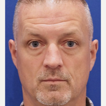 35-44 year old man treated with Eyelid Surgery before 3678785
