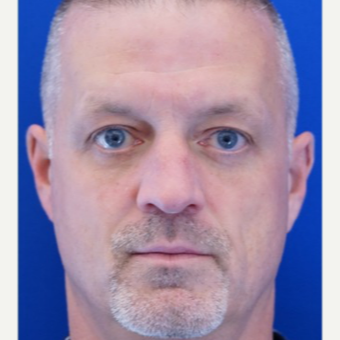 35-44 year old man treated with Eyelid Surgery after 3678785