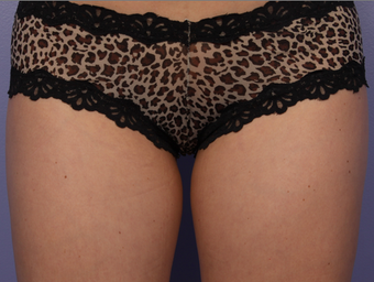Zeltiq CoolSculpting to Inner Thighs before 328283