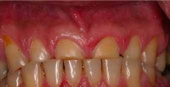 55-64 year old man treated with Smile Makeover before 3395146