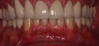 55-64 year old man treated with Smile Makeover after 3395146