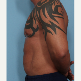 35-44 year old man treated with Fat Transfer after 3589538