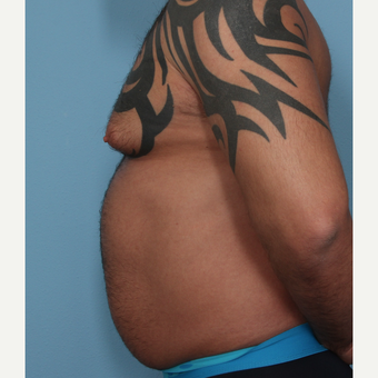 35-44 year old man treated with Fat Transfer before 3589538