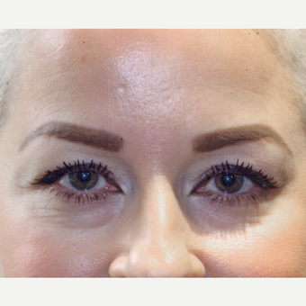 35-44 year old woman treated with Botox after 3083138