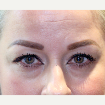 35-44 year old woman treated with Botox before 3083138
