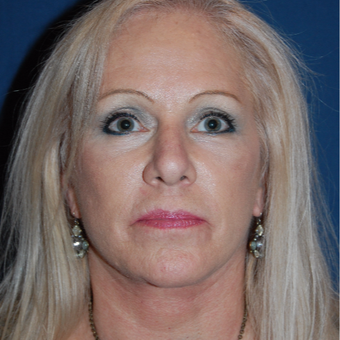 55-64 year old woman treated with Eyelid Surgery after 2976954