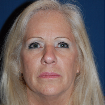 55-64 year old woman treated with Eyelid Surgery before 2976954