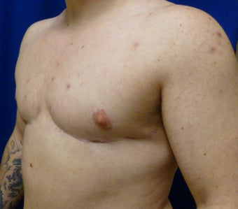 42 Year Old FTM Top Surgery 1278971
