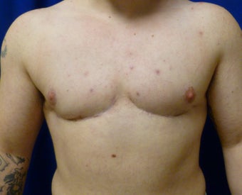 42 Year Old FTM Top Surgery after 1278971