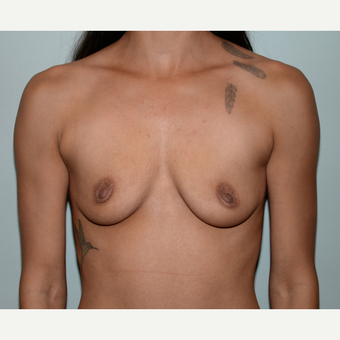 24 year old woman treated with Breast Augmentation before 3103136