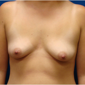 18-24 year old woman treated with Breast Lift with Implants before 3670235