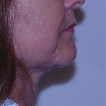 Double chin gone with liposuction alone after 3330939