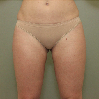 35-44 year old woman treated with CoolSculpting after 3098355