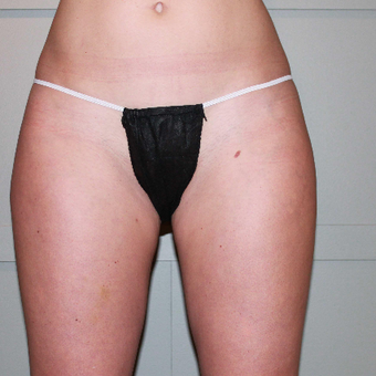 35-44 year old woman treated with CoolSculpting before 3098355