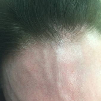 45-54 year old woman frontal veins. before 3590173