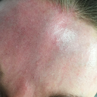 45-54 year old woman frontal veins. after 3590173
