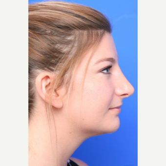 18-24 year old woman treated with Rhinoplasty after 3645364