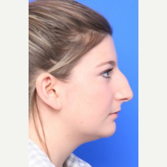 18-24 year old woman treated with Rhinoplasty before 3645364