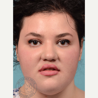 18-24 year old woman treated with open Rhinoplasty and base of nose narrowing before 3092685